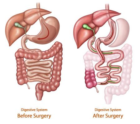 duodenal switch