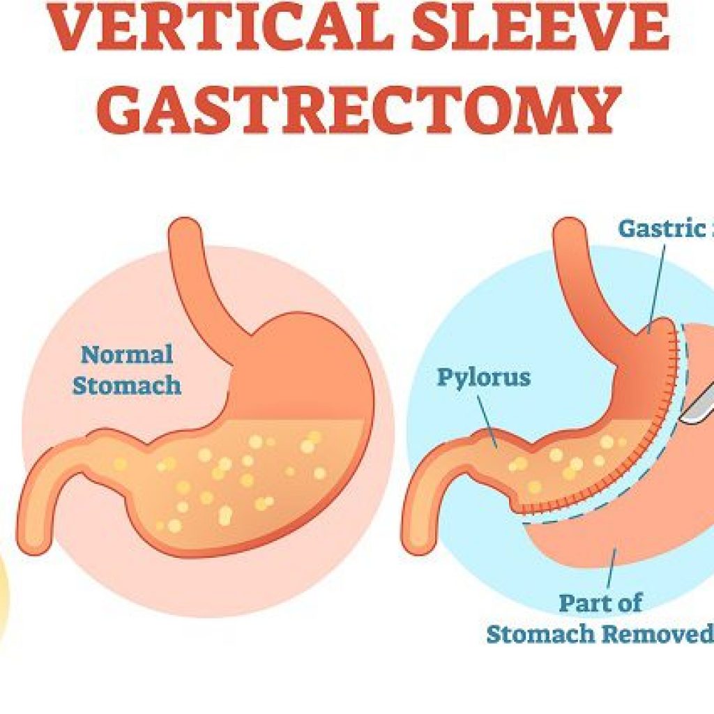 vertical sleeve gastrectomy