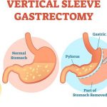 vertical sleeve gastrectomy