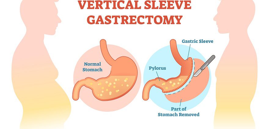 vertical sleeve gastrectomy