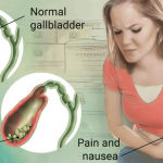 laparoscopic-cholecystectomy