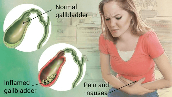 laparoscopic-cholecystectomy