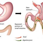 mini-gastric-bypass surgery