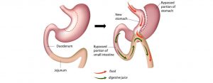 mini-gastric-bypass surgery